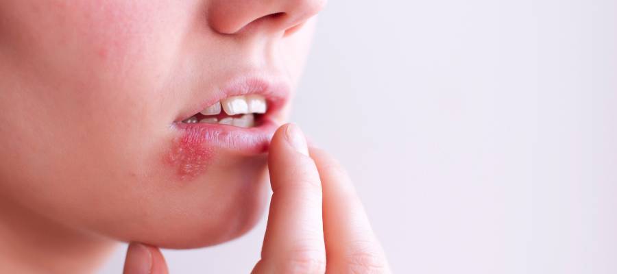 herpes na usni